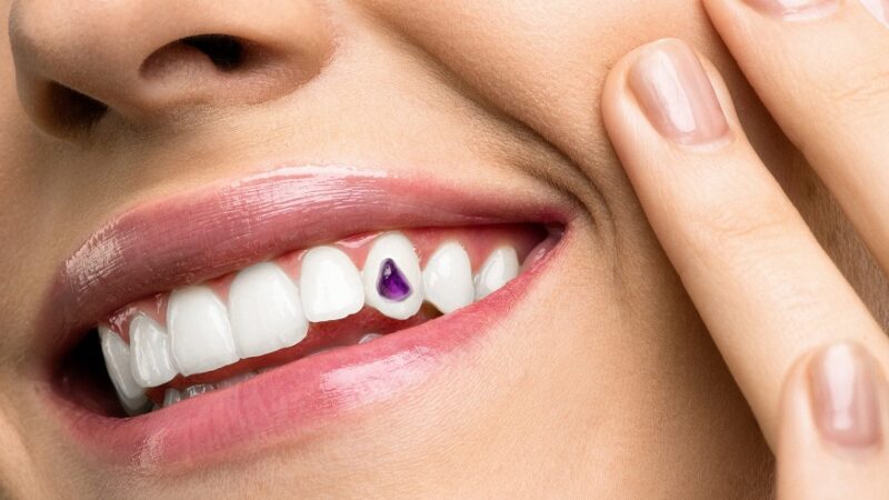 The New Trend? Why Celebrities Are Embracing Dental Bling